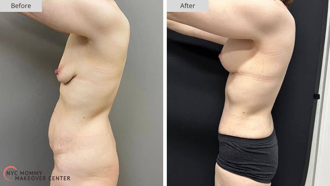 Mommy Makeover NYC Before and After #10a