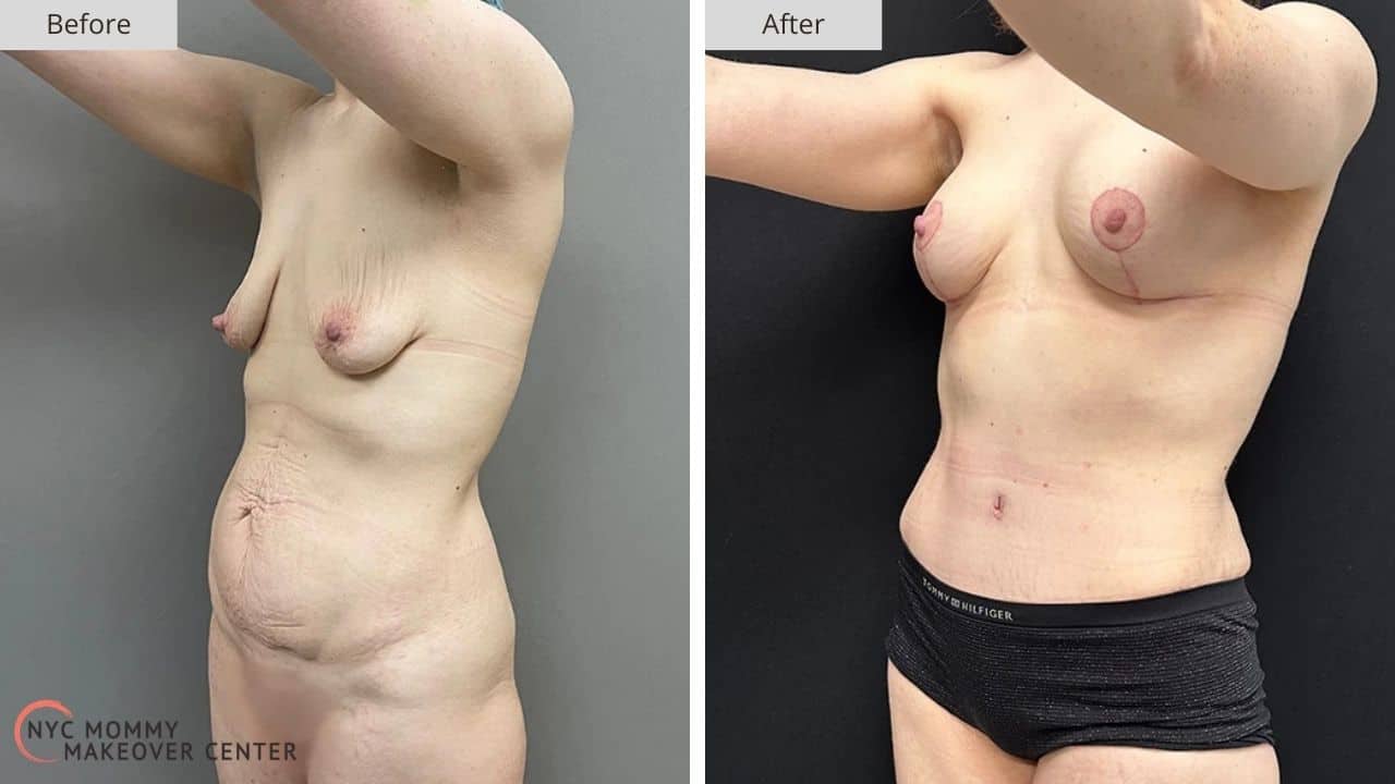 Mommy Makeover NYC Before and After #10b