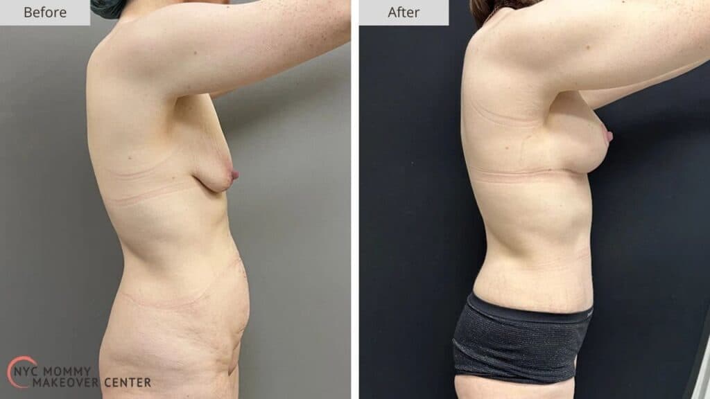 Mommy Makeover NYC Before and After #10c