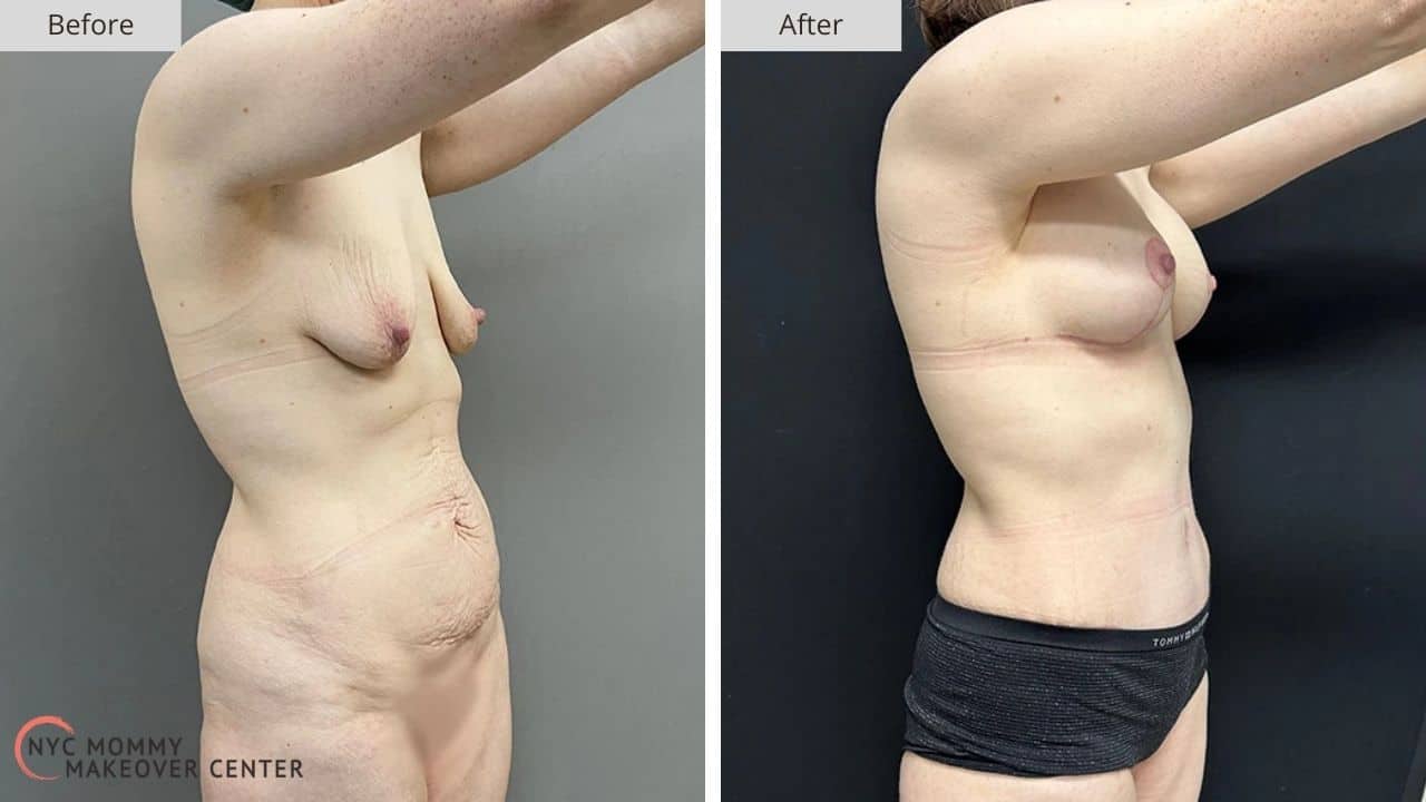 Mommy Makeover NYC Before and After #10d
