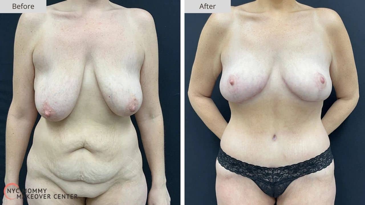Mommy Makeover NYC Before and After #11a