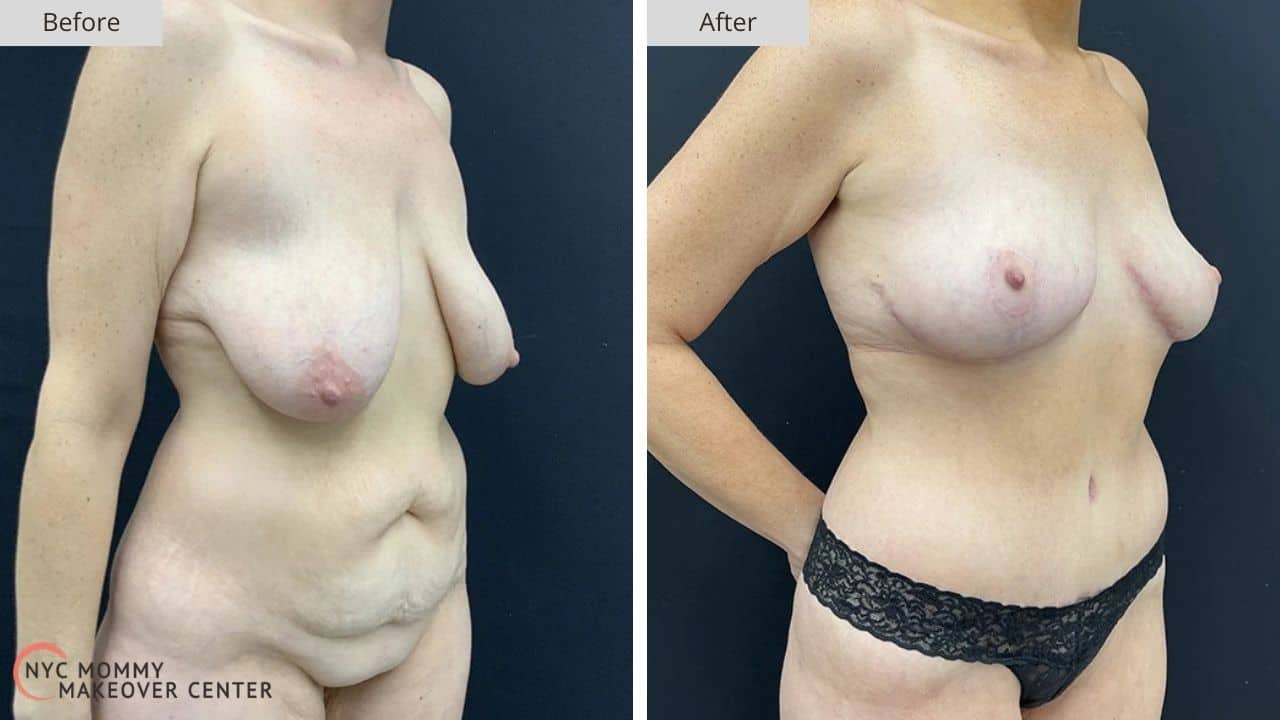 Mommy Makeover NYC Before and After #11b