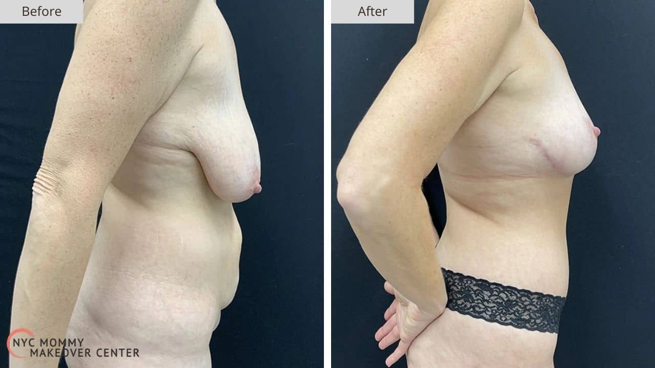 Mommy Makeover NYC Before and After #11c