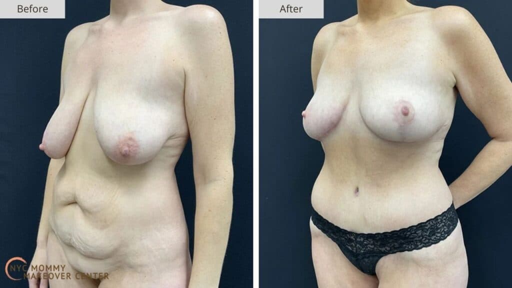 Mommy Makeover NYC Before and After #11d