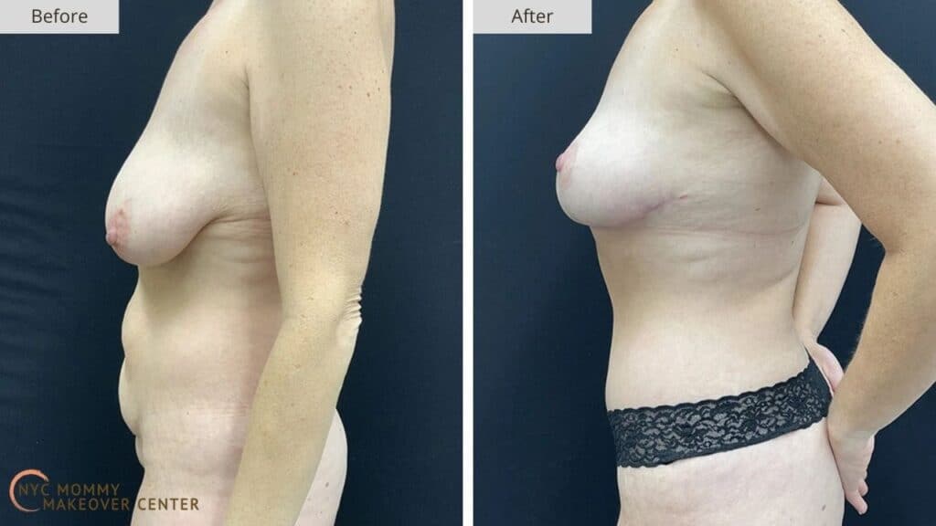 Mommy Makeover NYC Before and After #11e
