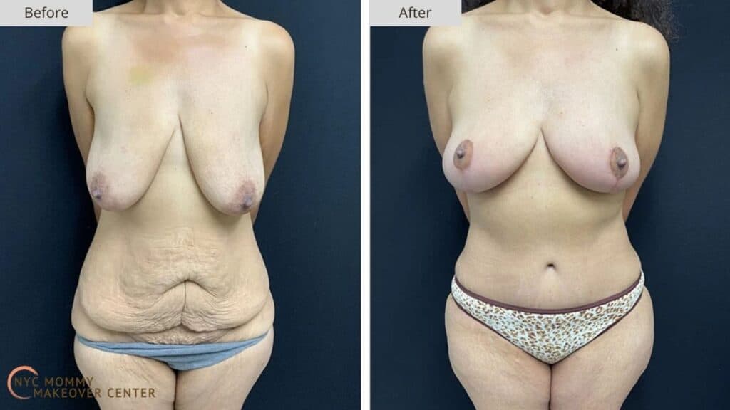 Mommy Makeover NYC Before and After #12a