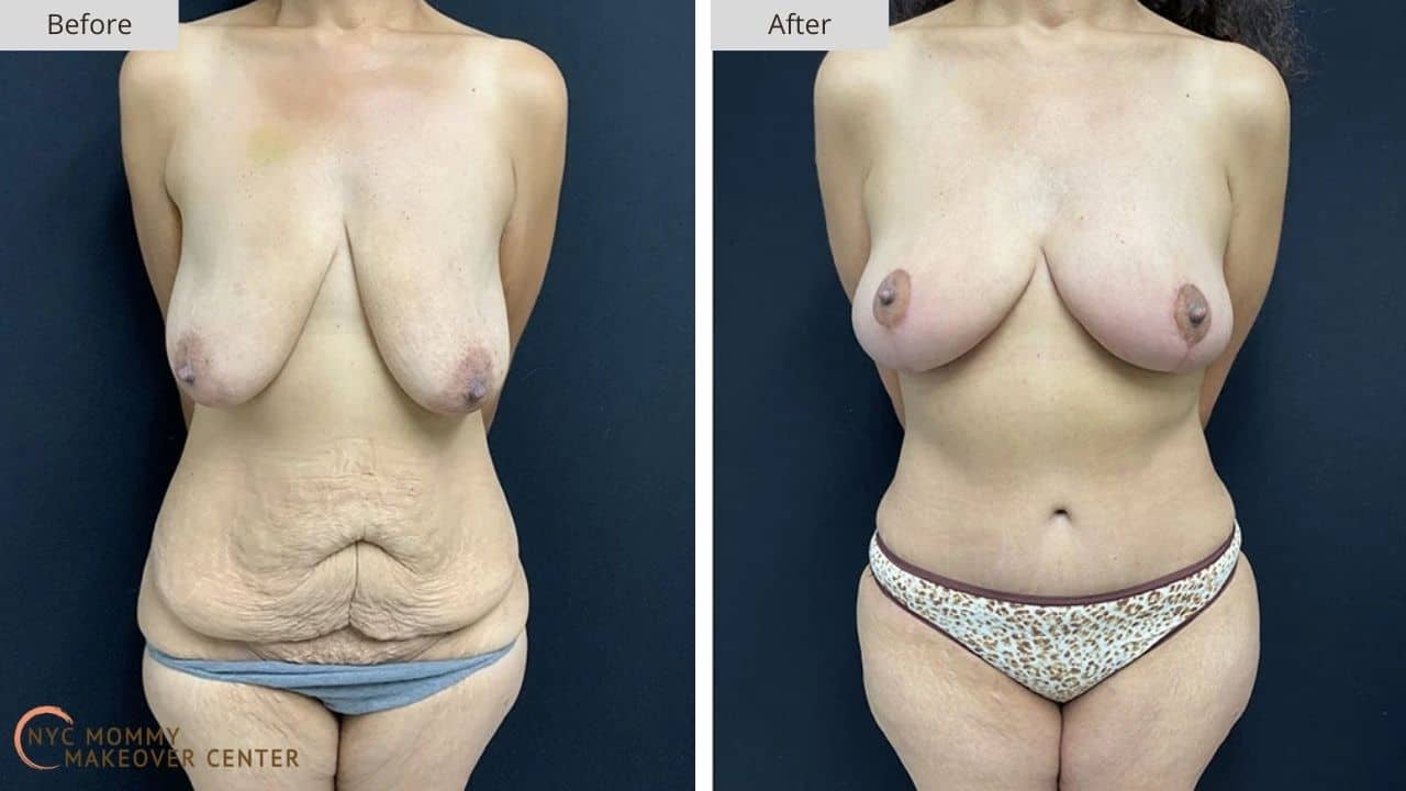 Mommy Makeover NYC Before and After #12a