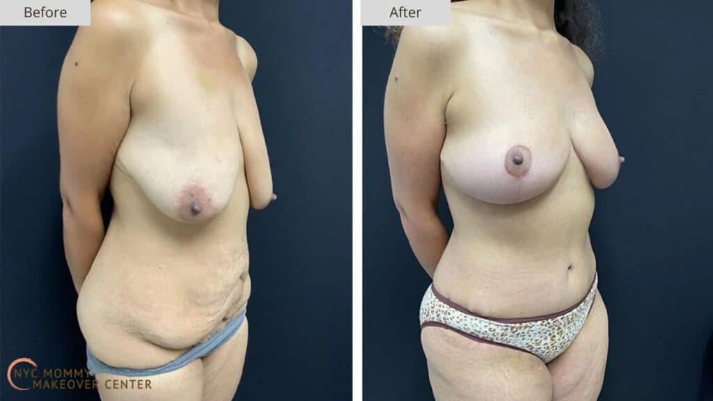 Mommy Makeover NYC Before and After #12b