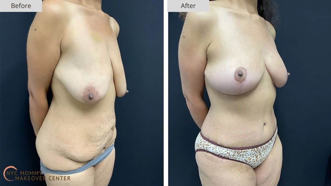Mommy Makeover NYC Before and After #12b