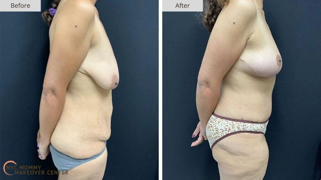 Mommy Makeover NYC Before and After #12c