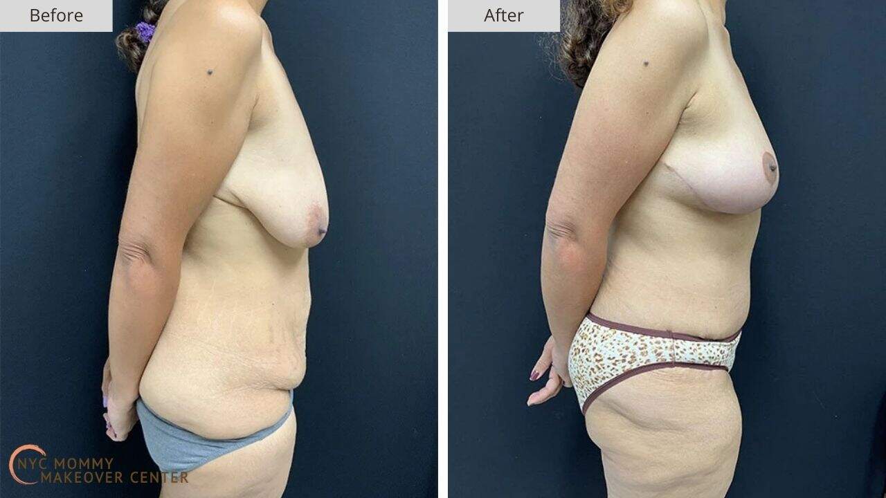Mommy Makeover NYC Before and After #12c