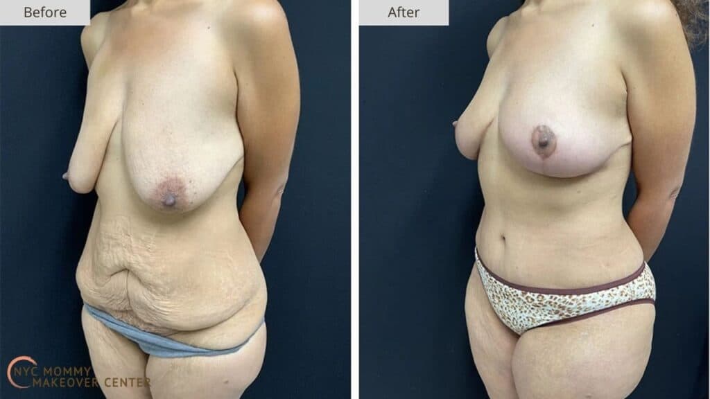 Mommy Makeover NYC Before and After #12d