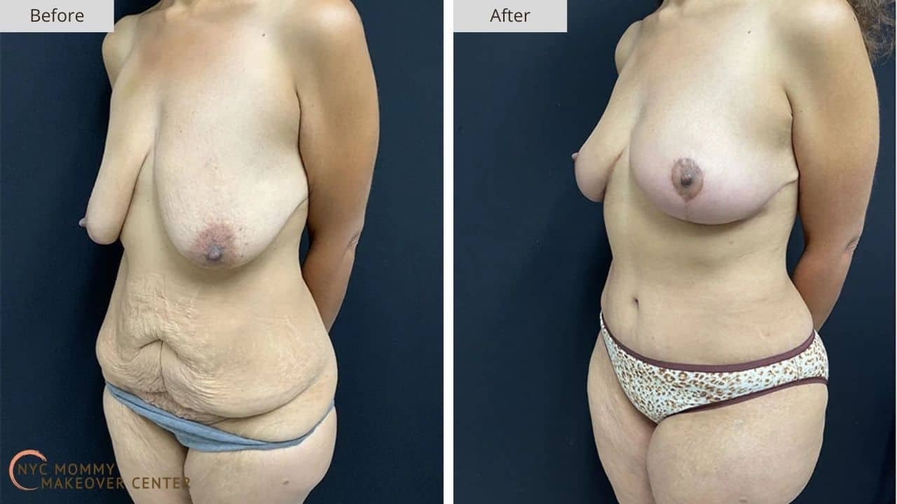 Mommy Makeover NYC Before and After #12d