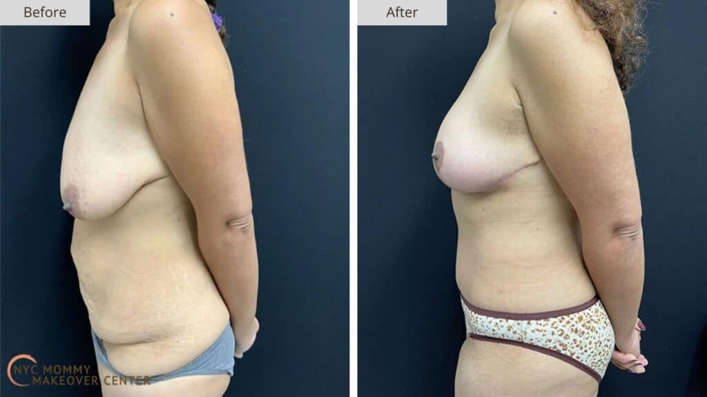 Mommy Makeover NYC Before and After #12e