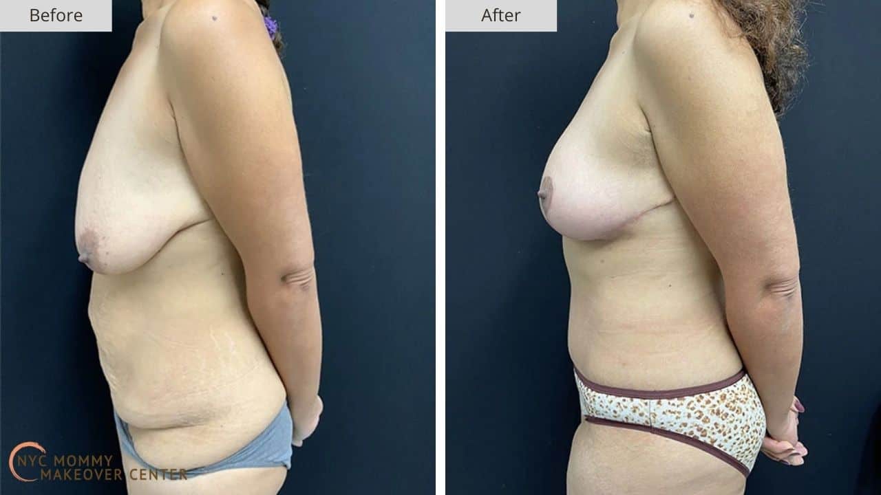 Mommy Makeover NYC Before and After #12e