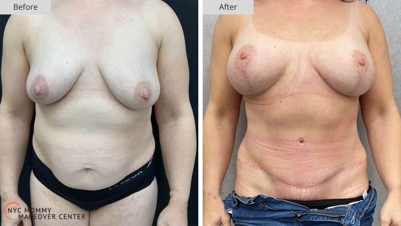 Mommy Makeover NYC Before and After #13a