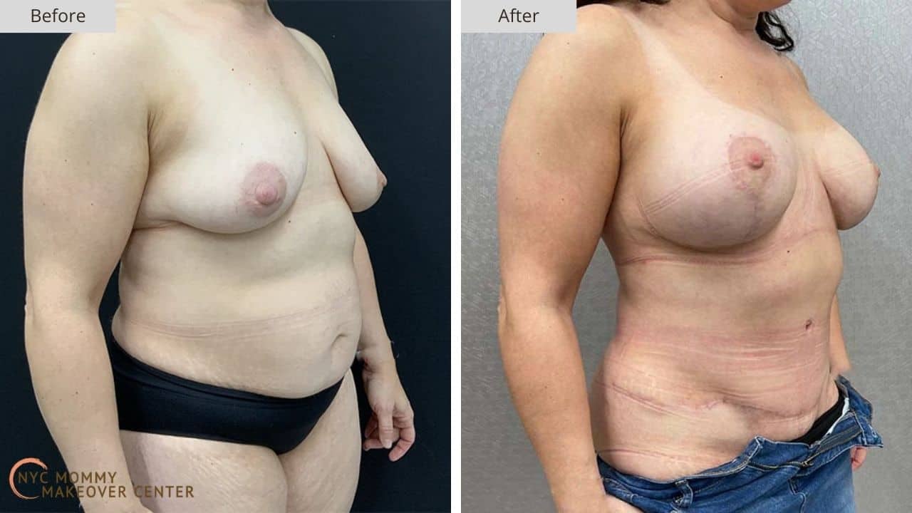 Mommy Makeover NYC Before and After #13b