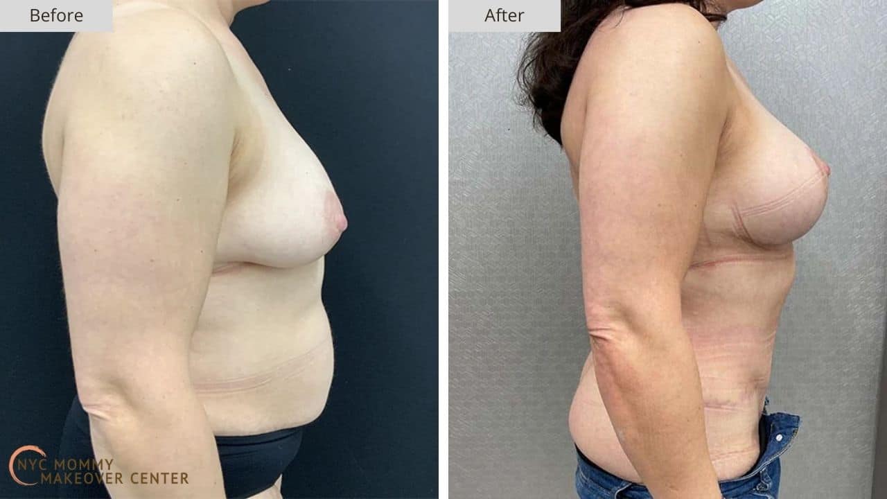 Mommy Makeover NYC Before and After #13c
