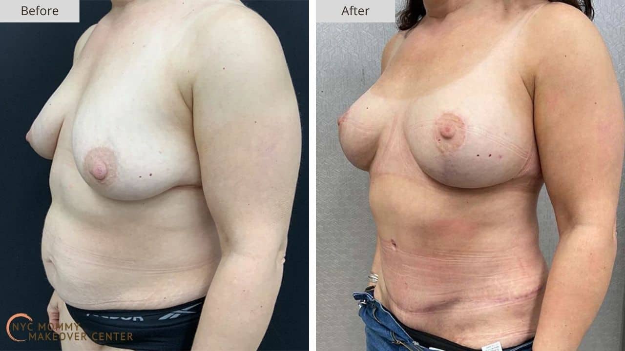 Mommy Makeover NYC Before and After #13d