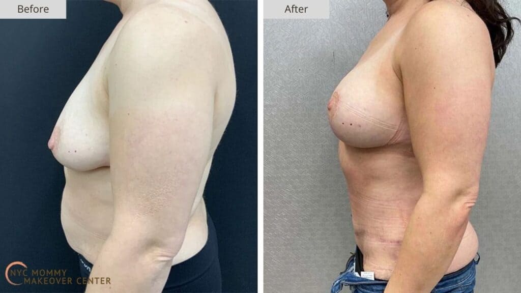 Mommy Makeover NYC Before and After #13e