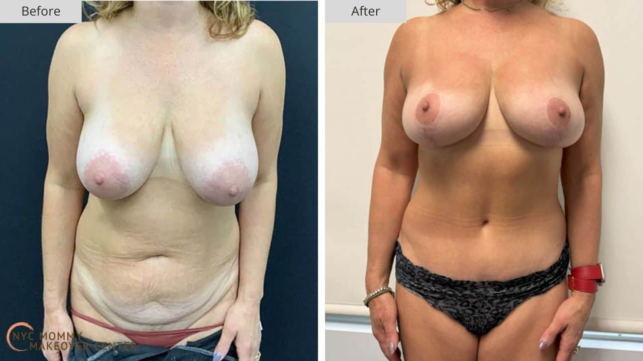 Mommy Makeover NYC Before and After #14a