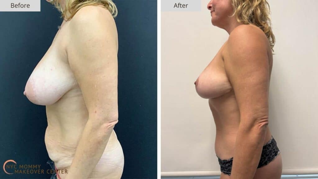 Mommy Makeover NYC Before and After #14b