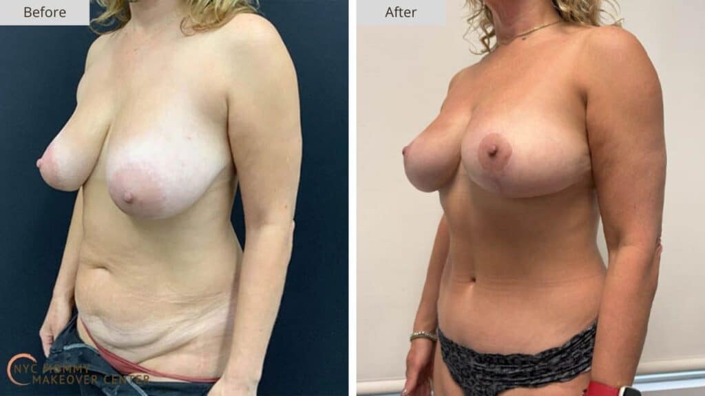 Mommy Makeover NYC Before and After #14c