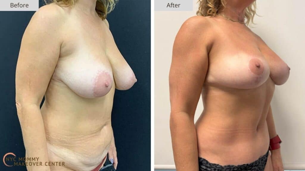 Mommy Makeover NYC Before and After #14e