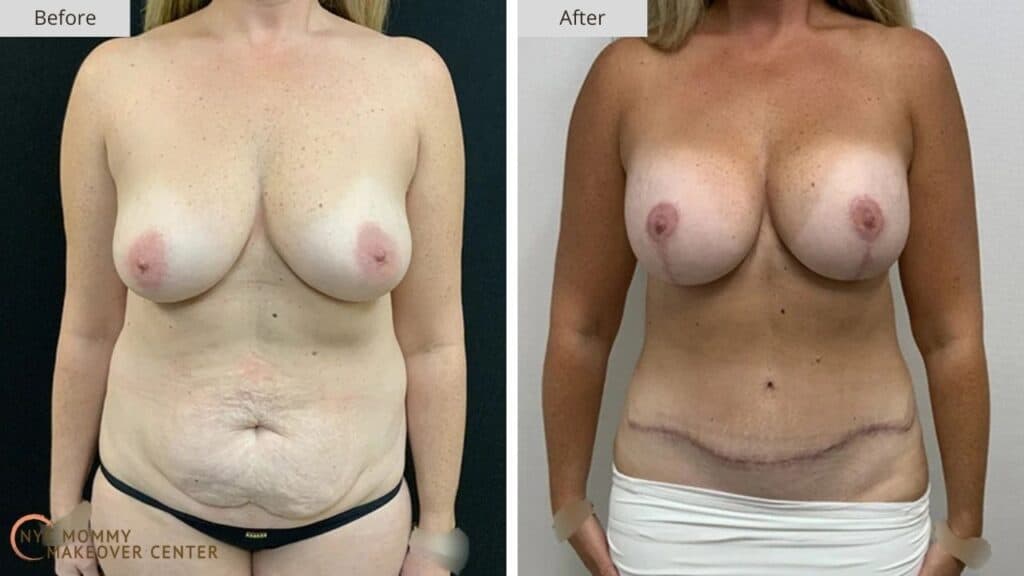 Mommy Makeover NYC Before and After #15a
