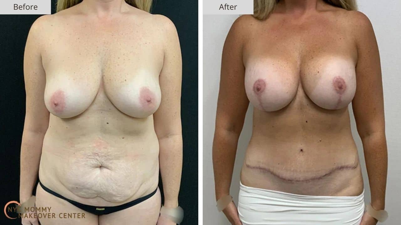 Mommy Makeover NYC Before and After #15a