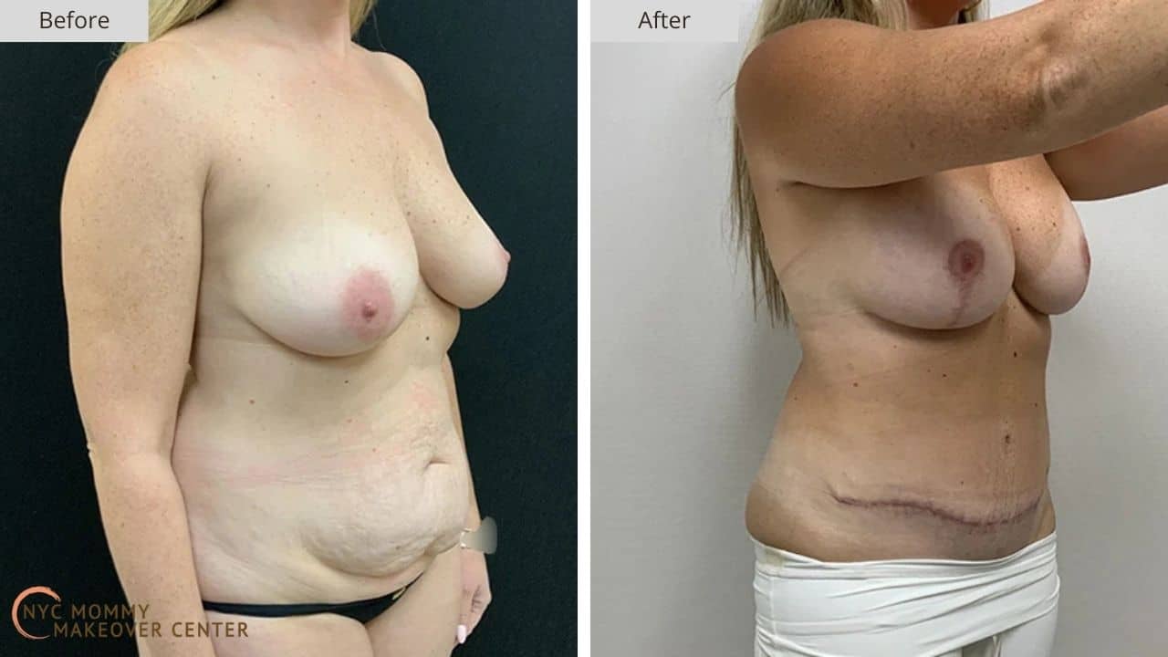 Mommy Makeover NYC Before and After #15b