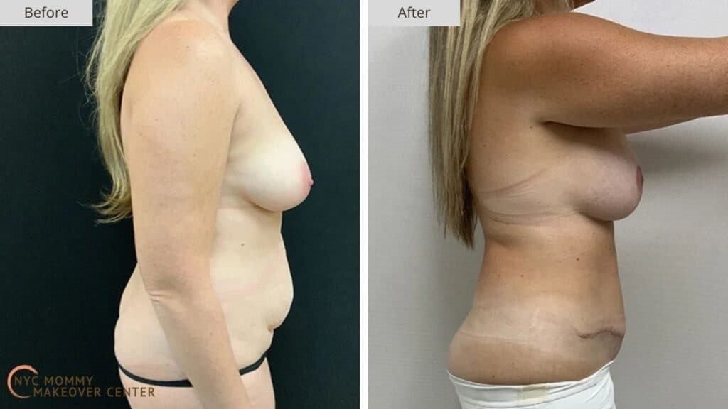 Mommy Makeover NYC Before and After #15c