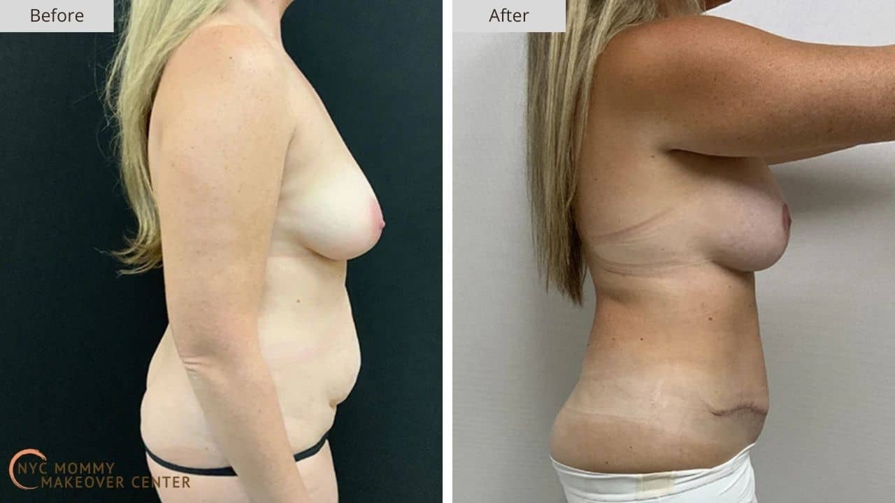 Mommy Makeover NYC Before and After #15c