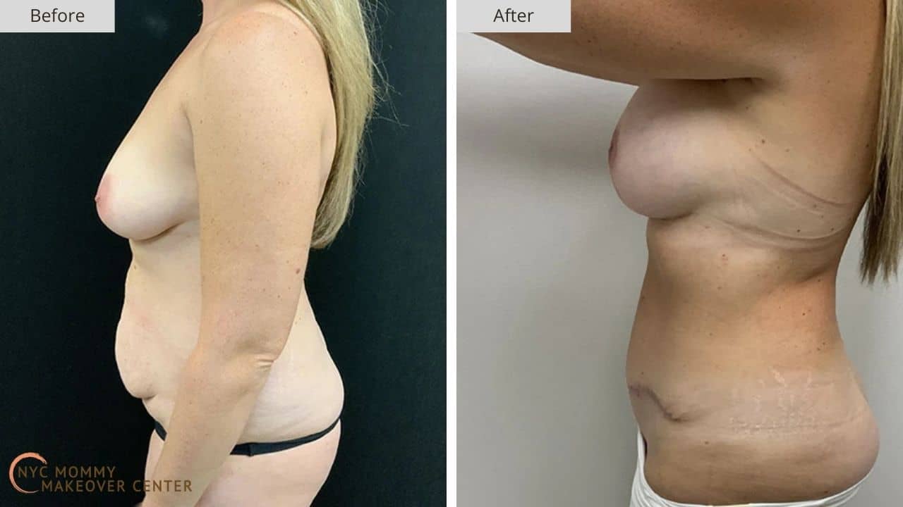 Mommy Makeover NYC Before and After #15e