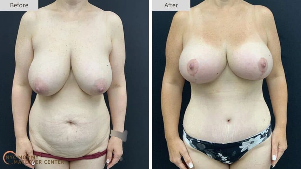 Mommy Makeover NYC Before and After #16a