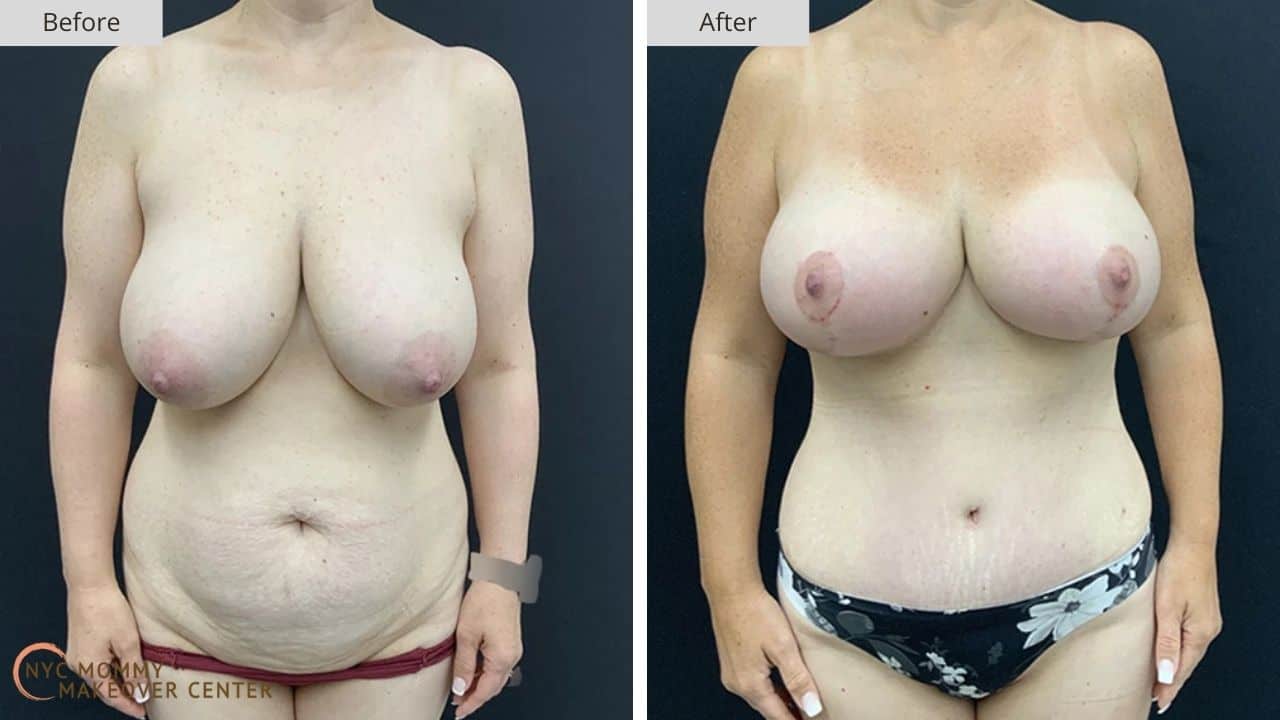 Mommy Makeover NYC Before and After #16a