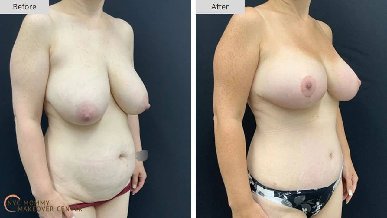 Mommy Makeover NYC Before and After #16b