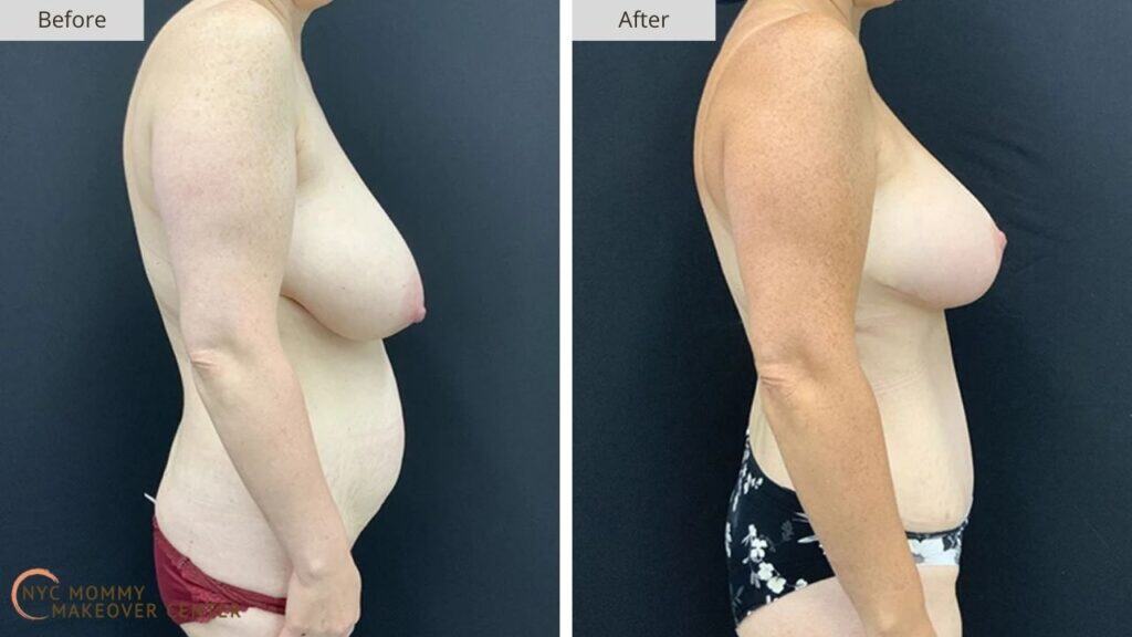 Mommy Makeover NYC Before and After #16c