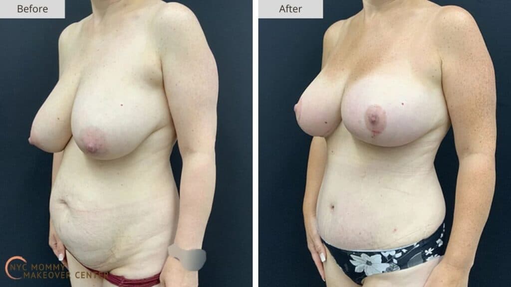 Mommy Makeover NYC Before and After #16d