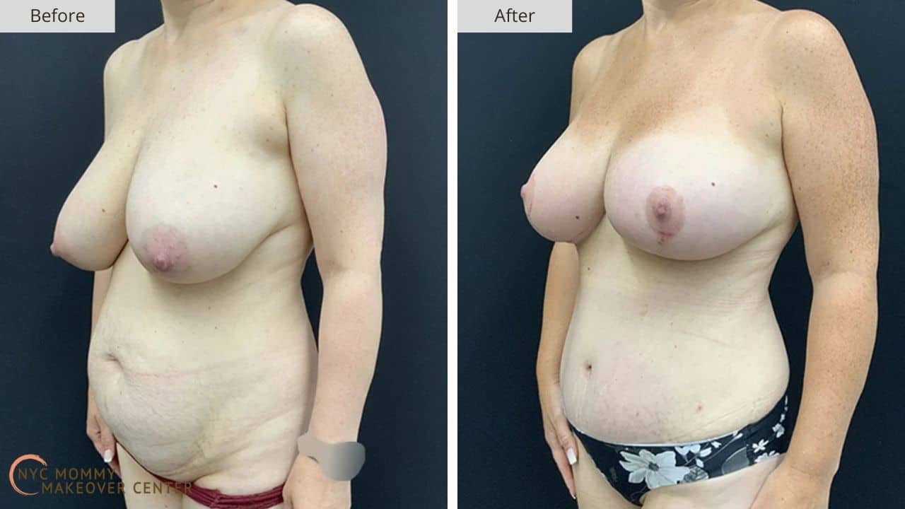 Mommy Makeover NYC Before and After #16d
