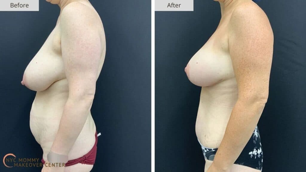 Mommy Makeover NYC Before and After #16e