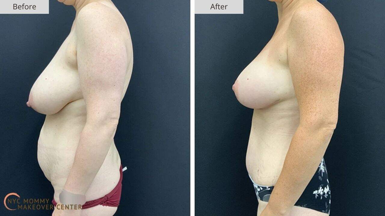 Mommy Makeover NYC Before and After #16e