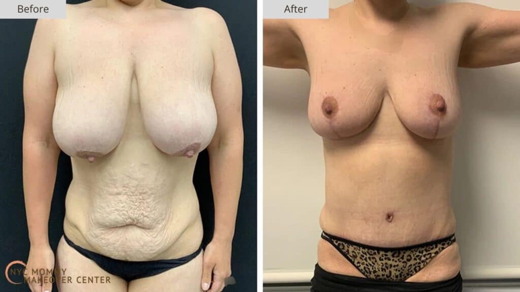 Mommy Makeover NYC Before and After #17a