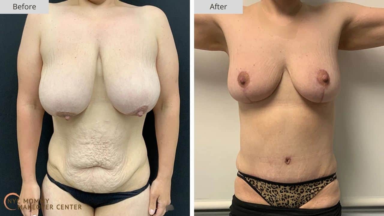 Mommy Makeover NYC Before and After #17a