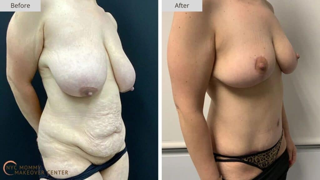Mommy Makeover NYC Before and After #17b