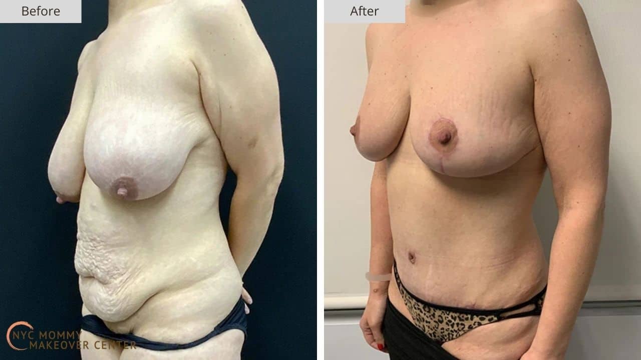 Mommy Makeover NYC Before and After #17c