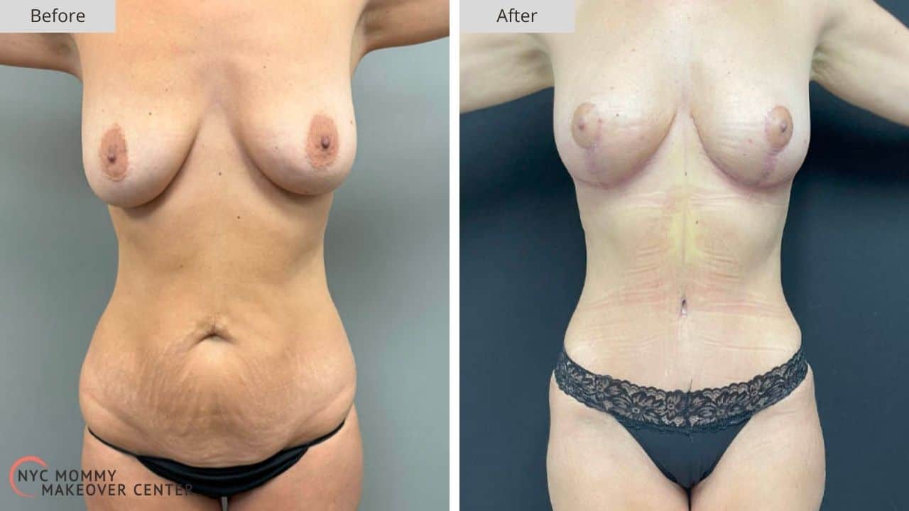 Mommy Makeover NYC Before and After #1a