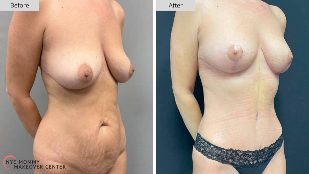 Mommy Makeover NYC Before and After #1b