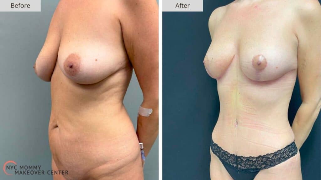 Mommy Makeover NYC Before and After #1e