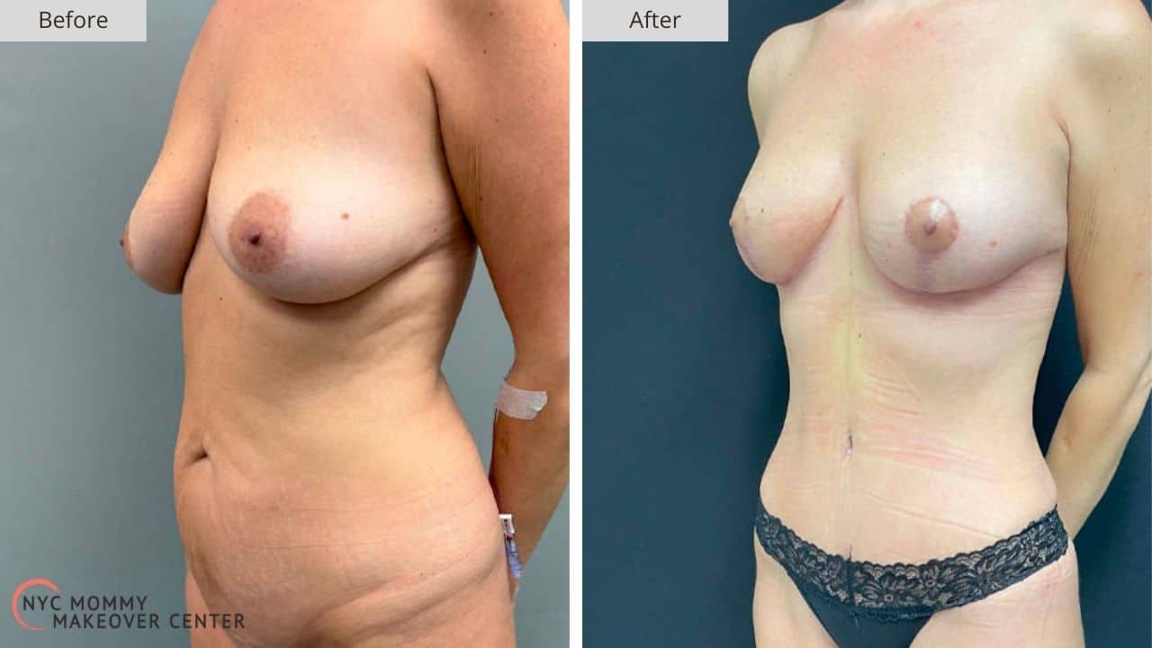 Mommy Makeover NYC Before and After #1e